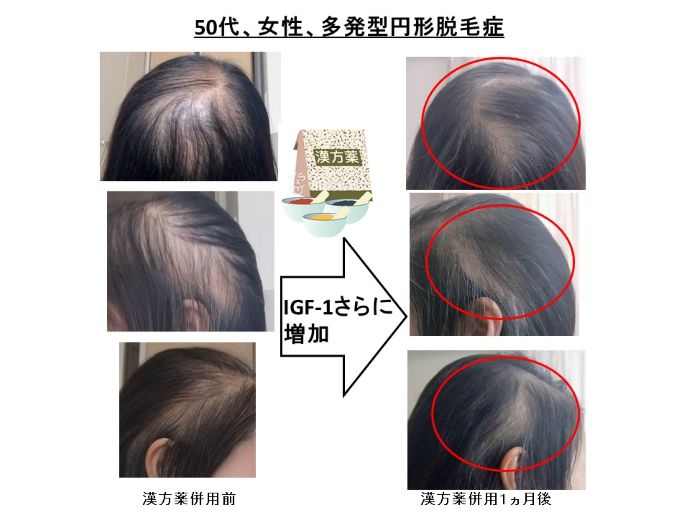 円形脱毛症　病院